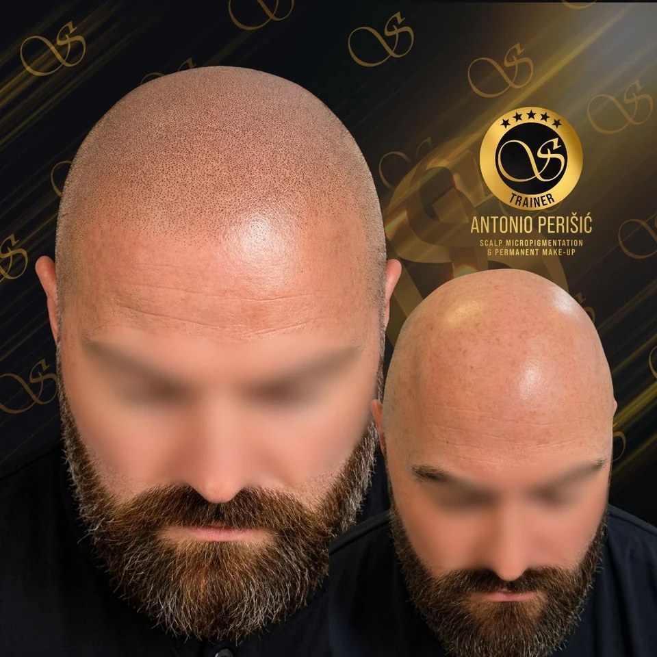 Pigmentacija vlasišta — SMP